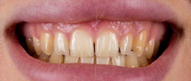 Faccette in ceramica prima del trattamento